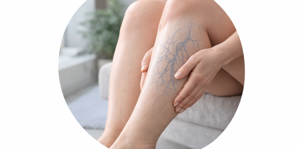 Maść na obrzęki nóg i zastój limfy – jak działa i kiedy ją stosować?